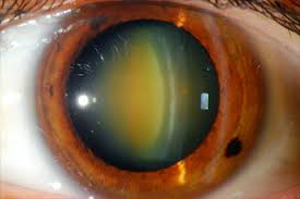 Cataract Surgery