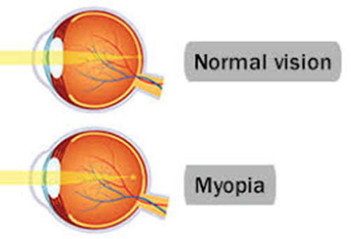 Myopia