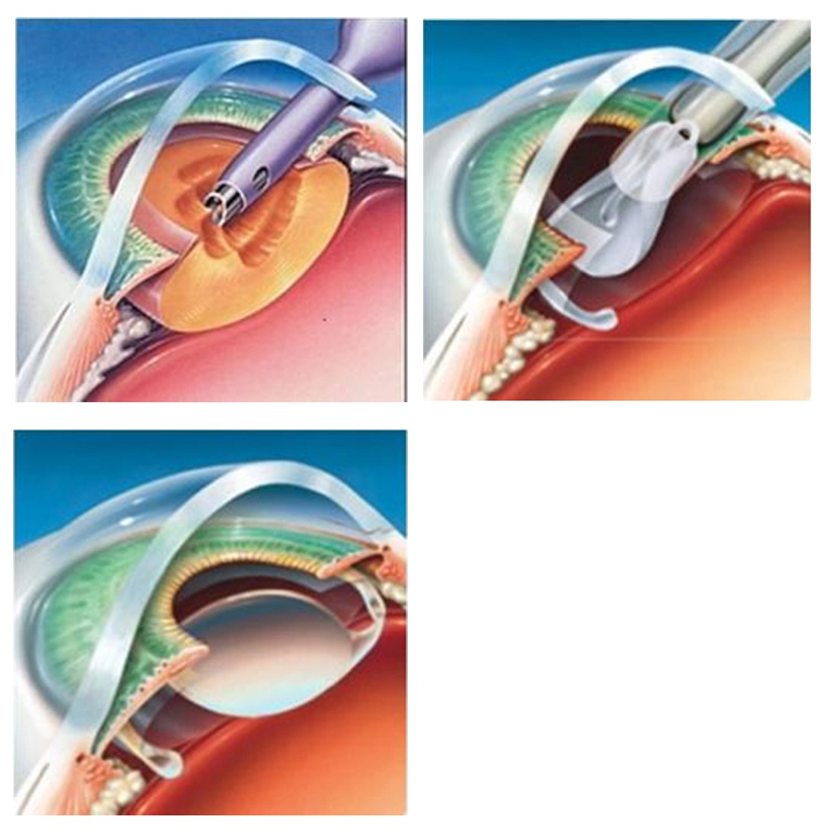 Cataract Surgery