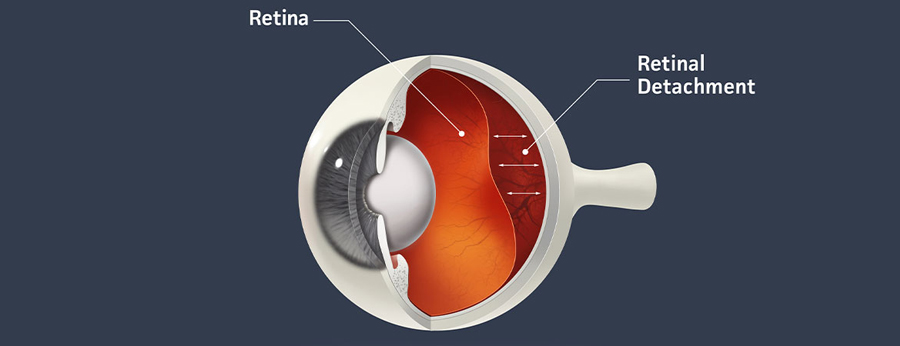 Retinal Detachment